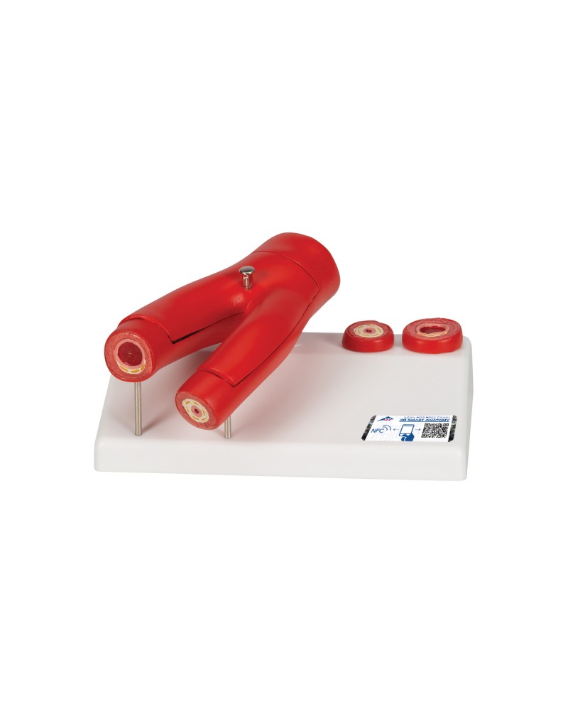 Arter çapraz kesitine sahip arterioskleroz model, 2 parçalı - 3B Smart Anatomy