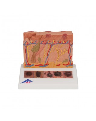 Deri Kanseri Modeli - 3B Smart Anatomy