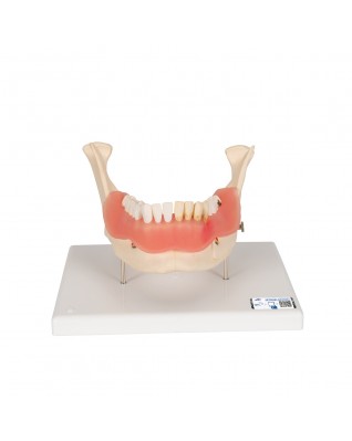 Diş Hastalıkları Modeli - 21 parça, 2 kat büyütülmüş - 3B Smart Anatomy