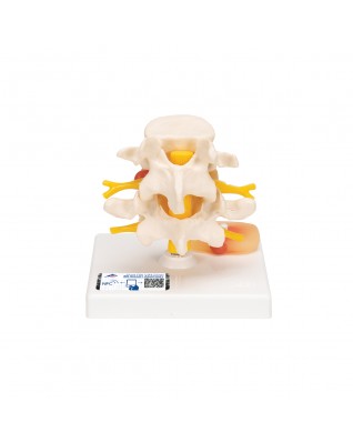 Bel fıtığına sahip bel omuru modeli - 3B Smart Anatomy