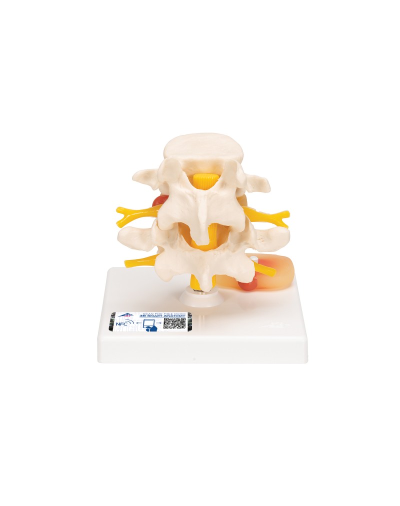 Bel fıtığına sahip bel omuru modeli - 3B Smart Anatomy