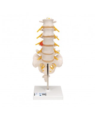 Dorsolateral bel fıtığına sahip bel omurgası - 3B Smart Anatomy