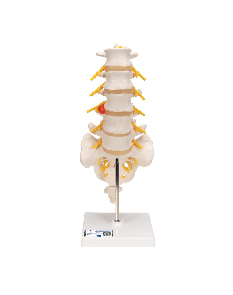 Dorsolateral bel fıtığına sahip bel omurgası - 3B Smart Anatomy