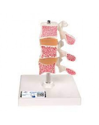 Lüks osteoporoz modeli (3 omur) - 3B Smart Anatomy