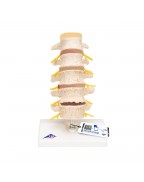 Bel fıtığı ve omur dejenerasyonu evreleri - 3B Smart Anatomy