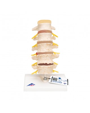Bel fıtığı ve omur dejenerasyonu evreleri - 3B Smart Anatomy