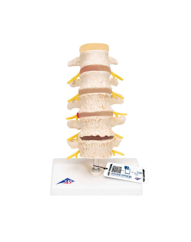 Bel fıtığı ve omur dejenerasyonu evreleri - 3B Smart Anatomy