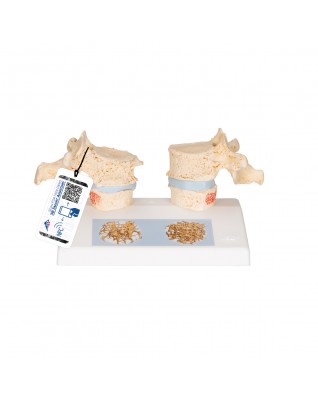 Osteoporoz modeli - 3B Smart Anatomy