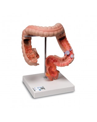 Bağırsak Hastalıkları Modeli - 3B Smart Anatomy
