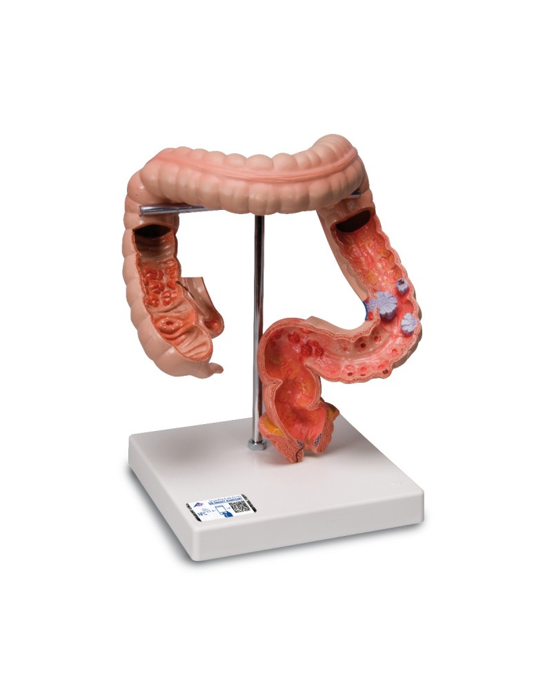 Bağırsak Hastalıkları Modeli - 3B Smart Anatomy