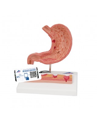 Mide ülserli mideler - 3B Smart Anatomy