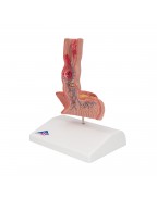 Yemek borusu hastalıkları - 3B Smart Anatomy