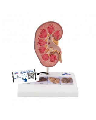 Böbrek taşı modeli - 3B Smart Anatomy