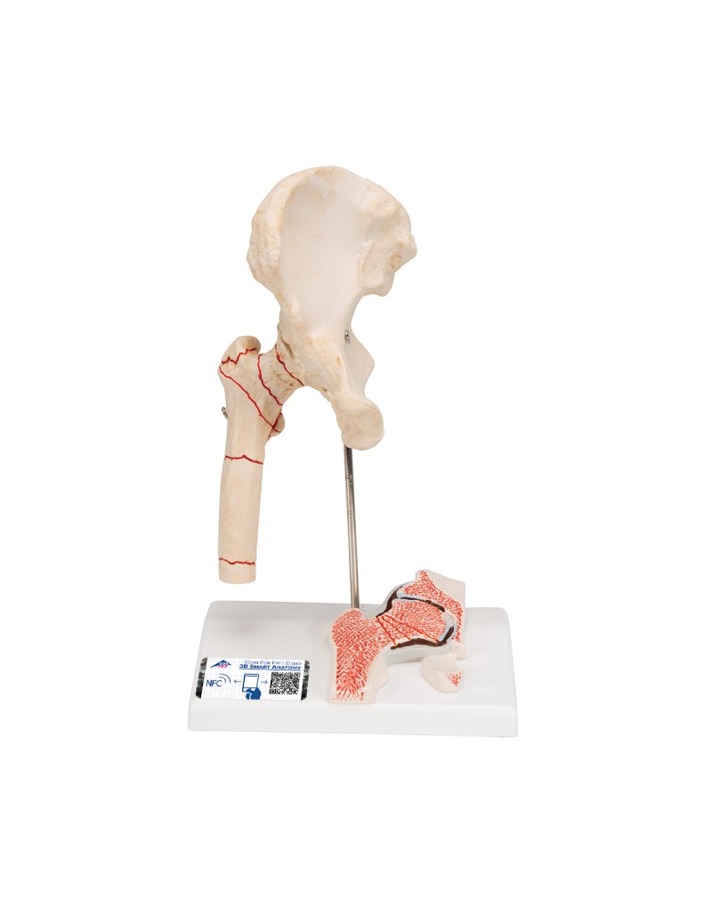 Femur kırık ve kalça osteoartriti - 3B Smart Anatomy