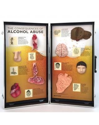 Alcohol Abuse Consequences 3-D Display
