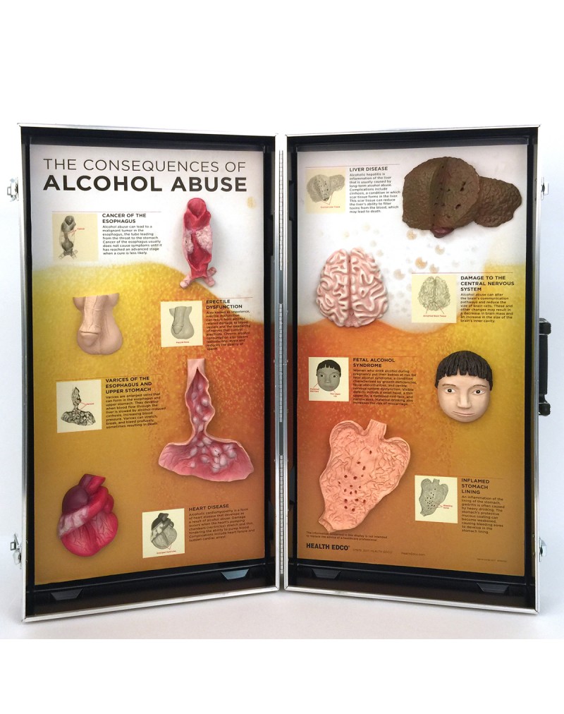 Alcohol Abuse Consequences 3-D Display