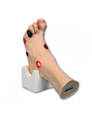 Wilma Wound Foot™