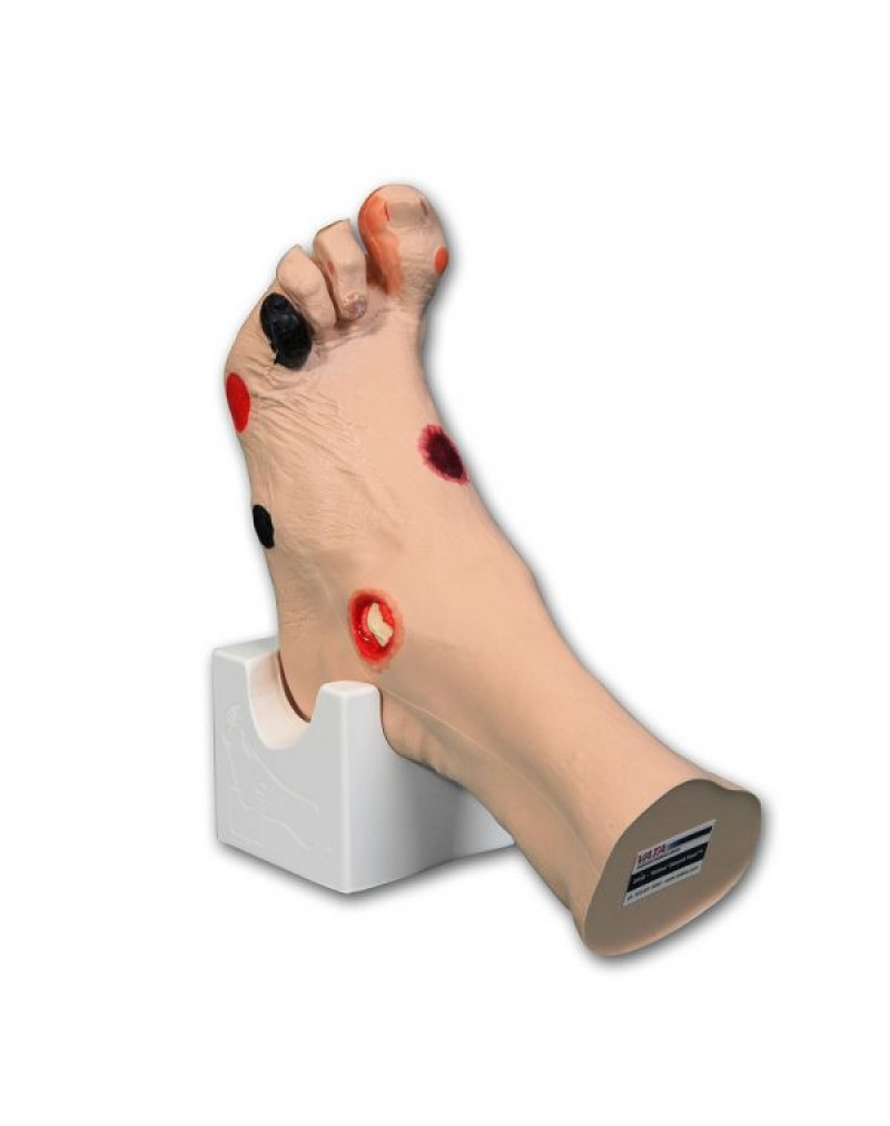 Wilma Wound Foot™